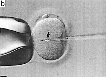 Olšūnas mākslīgā apaugļošana ar vienu spermatozoīdu